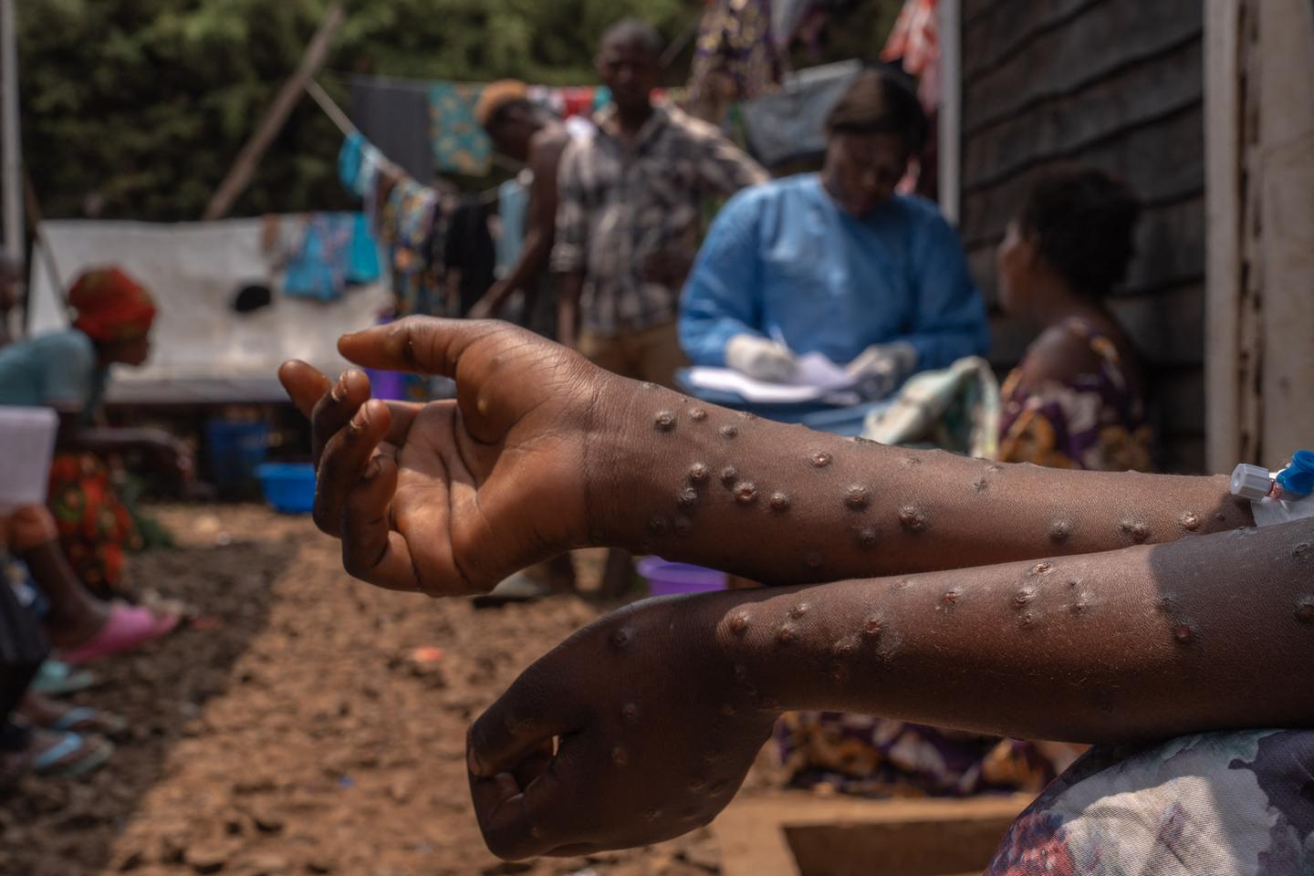 Mpox en Afrique : 866 décès depuis le début de l???année, selon l???agence sanitaire Africa...