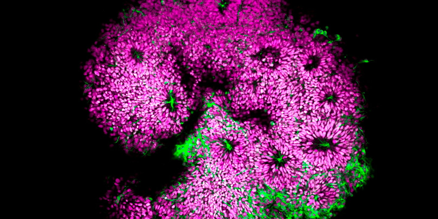 Maladie d???Alzheimer : ça commencerait avant la naissance