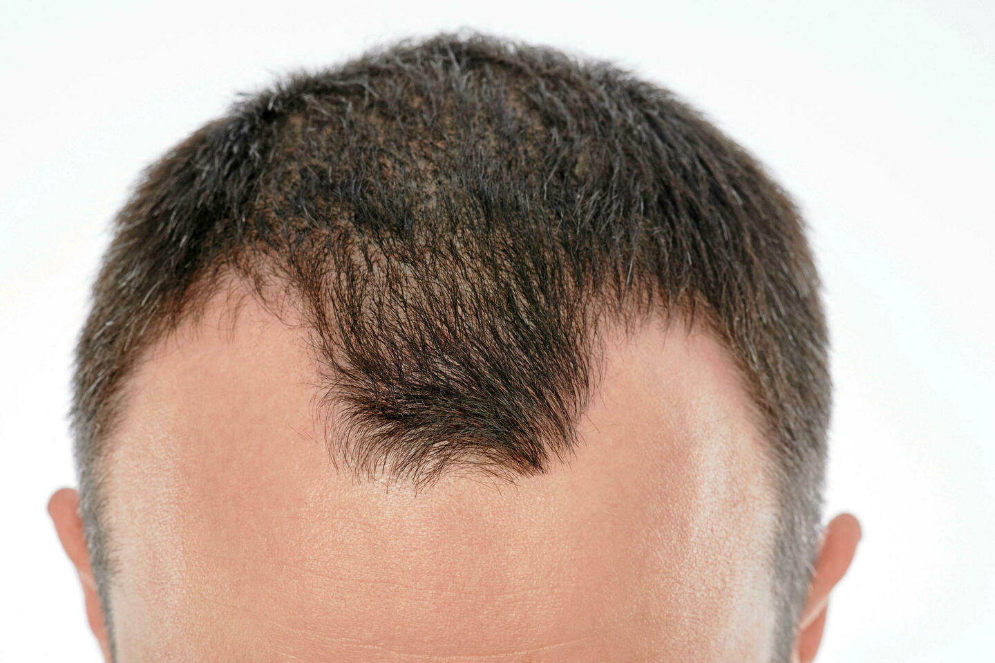 Calvitie : pourquoi les hommes perdent-ils plus leurs cheveux que les femmes ?