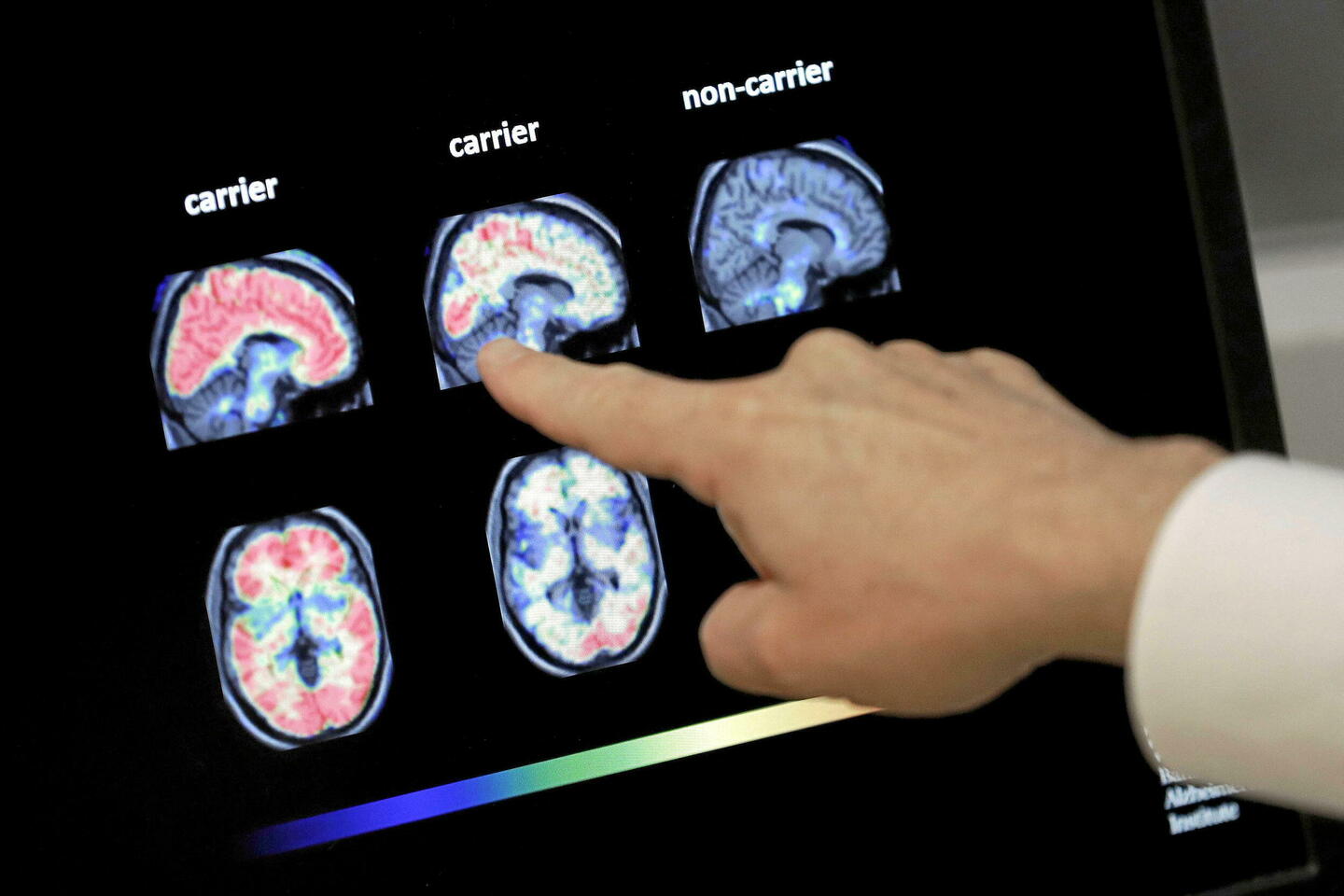 Alzheimer débutant : « Il faut lever les tabous ! »